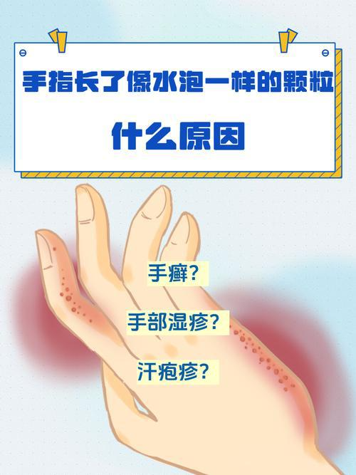 夏季手上反复长透明小水疱？汗疱疹识别与防治指南来了