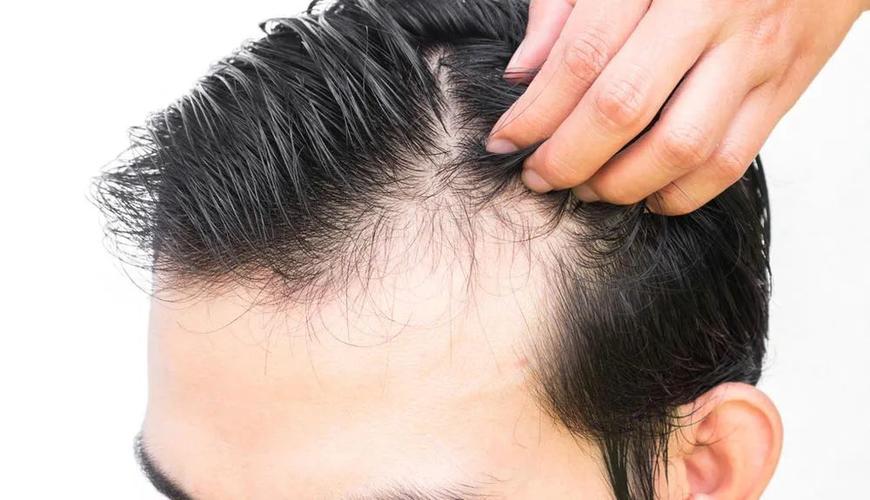 "脱发"有不同类型,治疗前先分清是哪一种